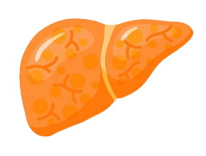 Metabolic dysfunction–Associated Steatosis (MAS)