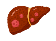 HCC(Hepatocellular Carcinoma)